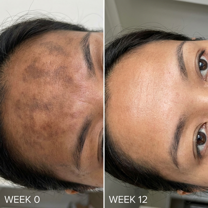 Revella's Cream for Melasma